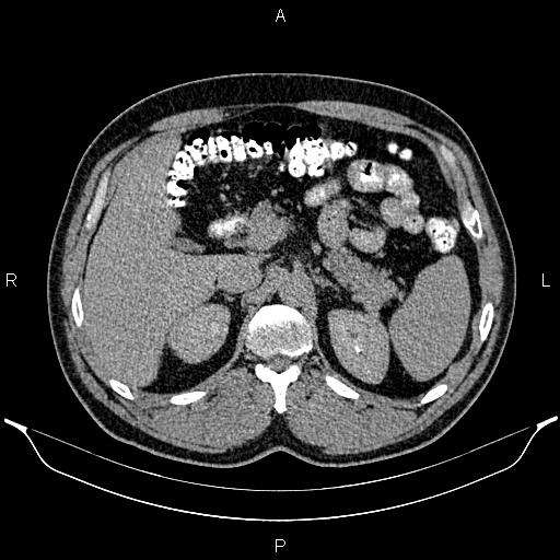 Acute appendicitis (Radiopaedia 84780-100240 Axial C+ delayed 31).jpg