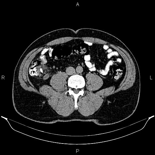 Acute appendicitis (Radiopaedia 84780-100240 Axial C+ delayed 64).jpg
