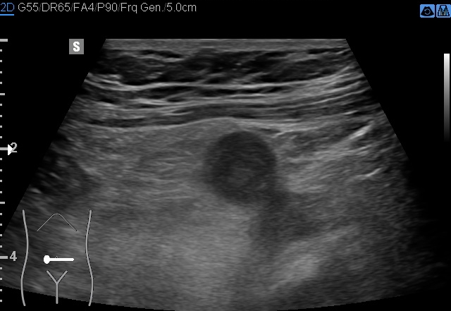 File:Acute appendicitis (Radiopaedia 85193-100745 D 149).jpg