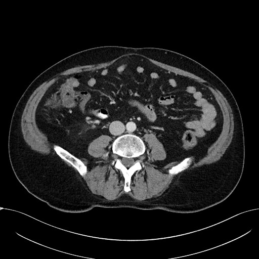 Acute appendicitis - large appendicoliths (Radiopaedia 61805-69820 Axial C+ portal venous phase 74).jpg