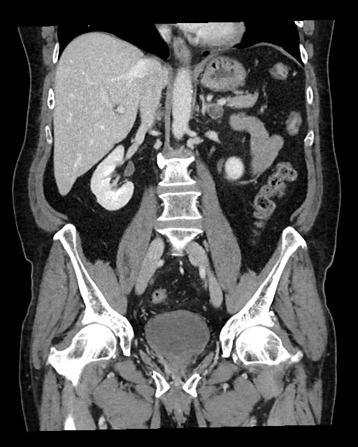 Acute appendicitis - large appendicoliths (Radiopaedia 61805-69820 Coronal C+ portal venous phase 74).jpg