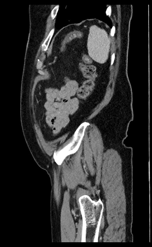 Acute appendicitis - large appendicoliths (Radiopaedia 61805-69820 Sagittal C+ portal venous phase 15).jpg