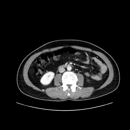 File:Acute appendicitis and COVID 19 pneumonia (Radiopaedia 76604-88380 Axial C+ portal venous phase 41).jpg