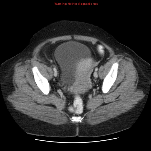 Acute appendicitis complicated by ovarian vein thrombophlebitis (Radiopaedia 16172-15851 Axial C+ portal venous phase 77).jpg