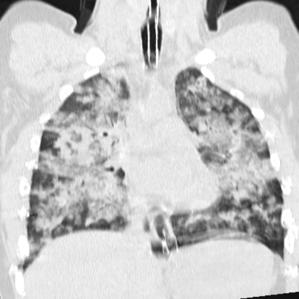 Acute aspiration pneumonitis (Radiopaedia 33605-34703 Coronal lung window 42).jpg