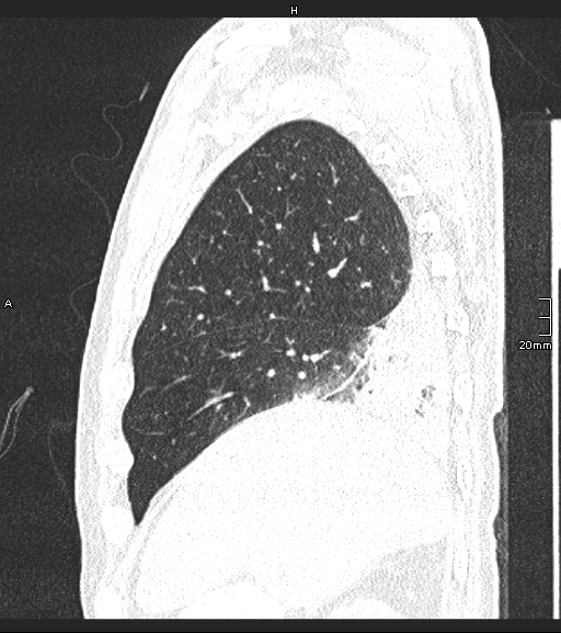 Acute aspiration pneumonitis (Radiopaedia 55642-62166 Sagittal lung window 121).jpg