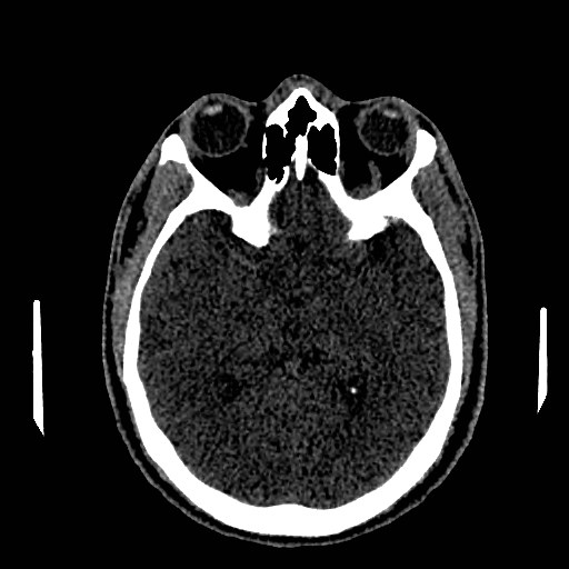 Acute basilar artery occlusion (Radiopaedia 43582-46985 Axial non-contrast 86).jpg