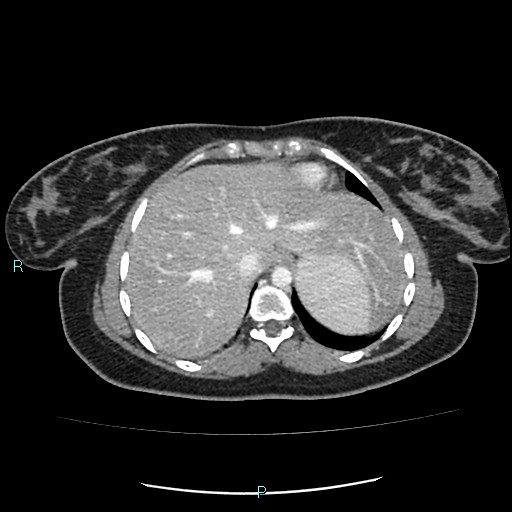 Acute bilateral pyelonephritis (Radiopaedia 37146-38881 Axial C+ portal venous phase 10).jpg