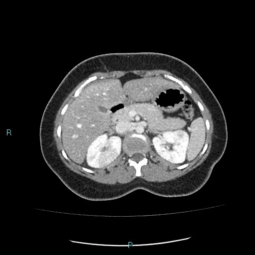 File:Acute bilateral pyelonephritis (Radiopaedia 37146-38881 Axial C+ portal venous phase 35).jpg