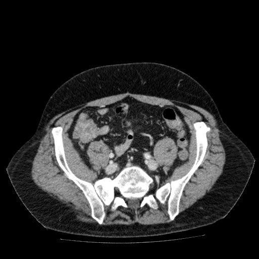 Acute cholecystitis and incidental left sided IVC (Radiopaedia 49352-54459 Axial C+ portal venous phase 114).jpg