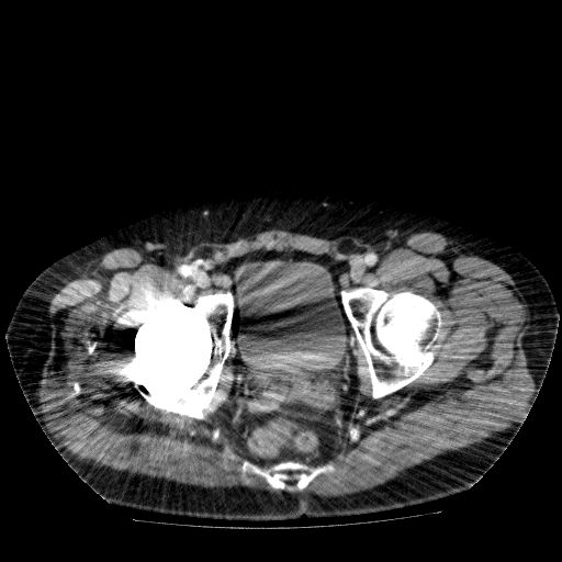 File:Acute cholecystitis and incidental left sided IVC (Radiopaedia 49352-54459 Axial C+ portal venous phase 146).jpg