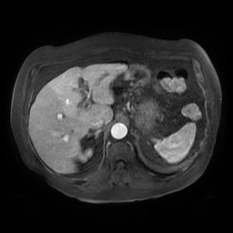 Acute cholecystitis complicated by pylephlebitis (Radiopaedia 65782-74915 Axial arterioportal phase T1 C+ fat sat 40).jpg