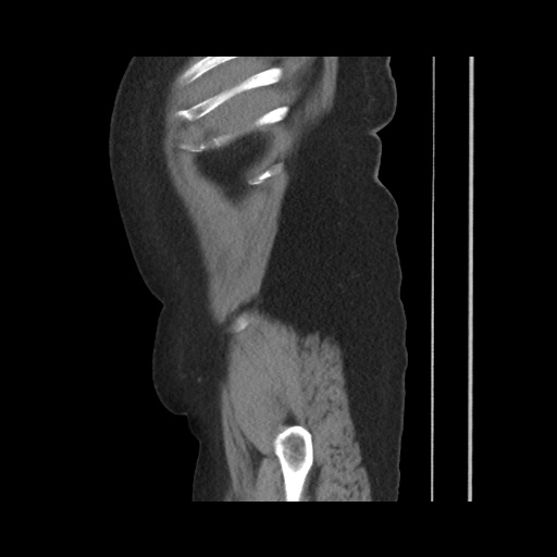 Acute cholecystitis with tensile fundus sign (Radiopaedia 71394-81723 Sagittal non-contrast 36).jpg