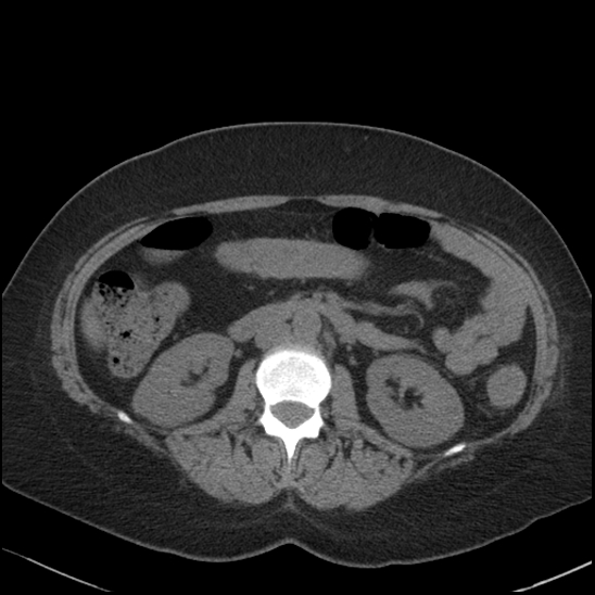 Acute colonic hemorrhage in ulcerative colitis (Radiopaedia 77415-89538 Axial non-contrast 59).jpg