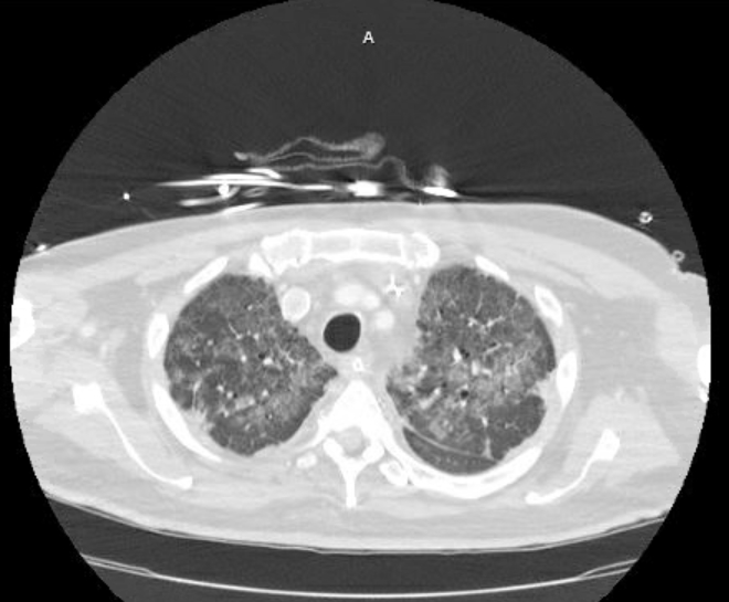 File:Acute cor pulmonale (ultrasound) (Radiopaedia 83508-98818 Axial 53).jpg