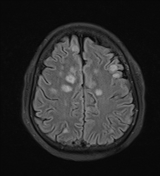 File:Acute disseminated encephalomyelitis (Radiopaedia 37253-39033 Axial FLAIR 20).jpg