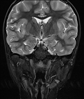 File:Acute disseminating encephalomyelitis with bilateral optic neuritis (Radiopaedia 79676-92886 Coronal STIR 19).jpg