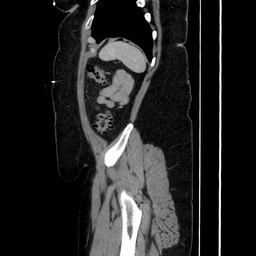 Acute diverticulitis - transverse colon (Radiopaedia 87063-103327 Sagittal C+ portal venous phase 180).jpg
