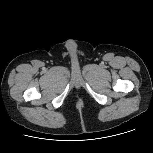 Acute diverticulitis with localized perforation (Radiopaedia 41296-44113 Axial C+ portal venous phase 100).jpg