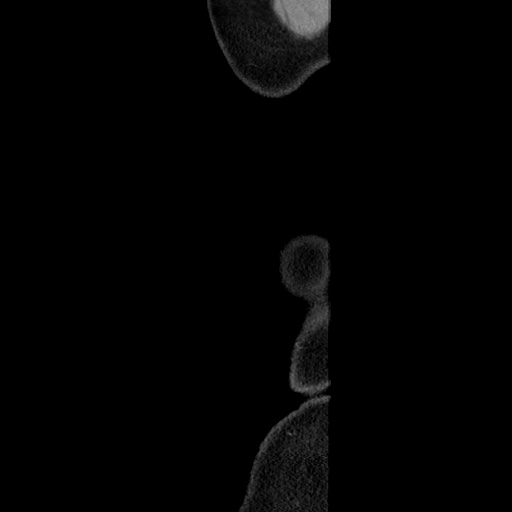 Acute diverticulitis with localized perforation (Radiopaedia 41296-44113 Sagittal C+ portal venous phase 4).jpg