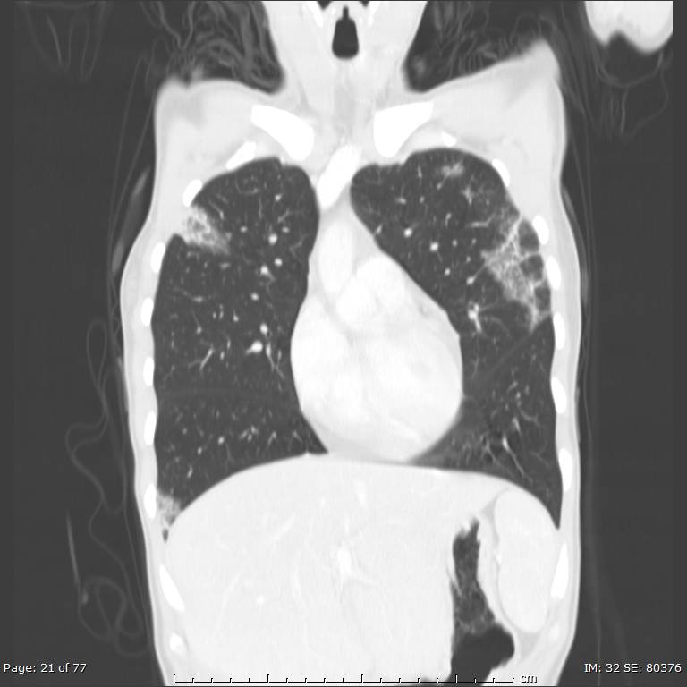 Acute eosinophilic pneumonia (Radiopaedia 48211-53073 Coronal lung window 13).jpg
