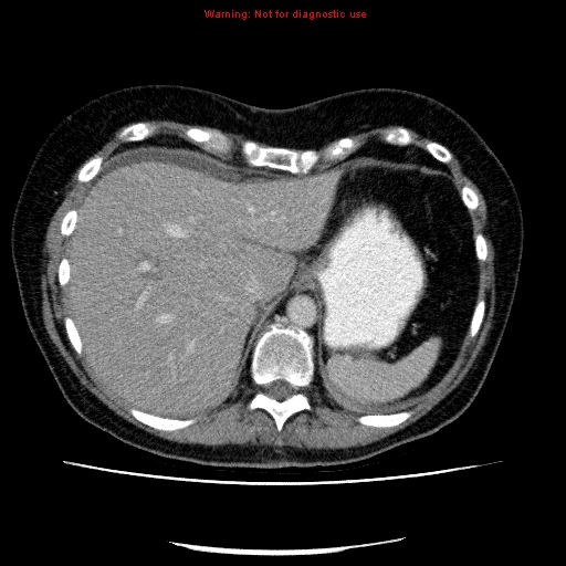 File:Acute gangrenous cholecystitis (Radiopaedia 10123-10661 Axial C+ portal venous phase 18).jpg