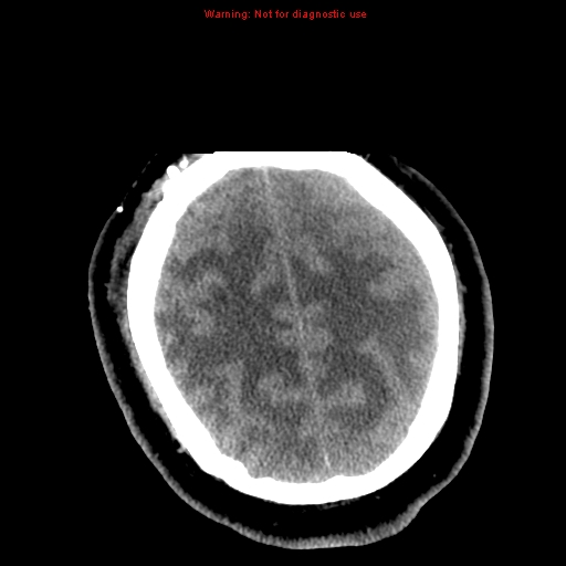 File:Acute hemorrhagic leukoencephalitis (Radiopaedia 14076-72275 Axial non-contrast 35).jpg