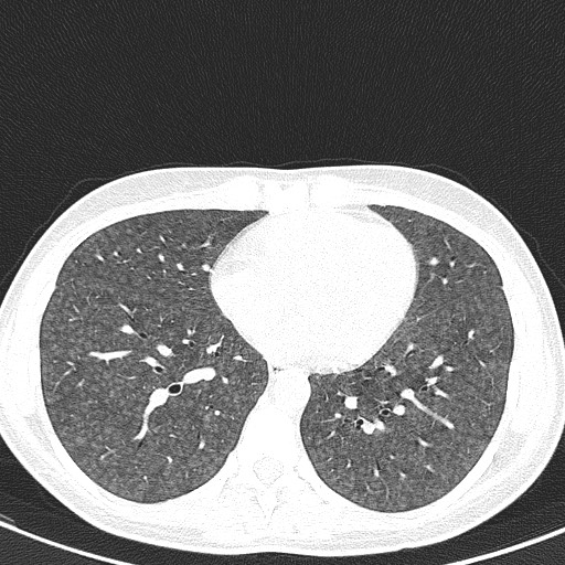 File:Acute hypersensitivity pneumonitis (Radiopaedia 85293-100870 Axial lung window 78).jpg