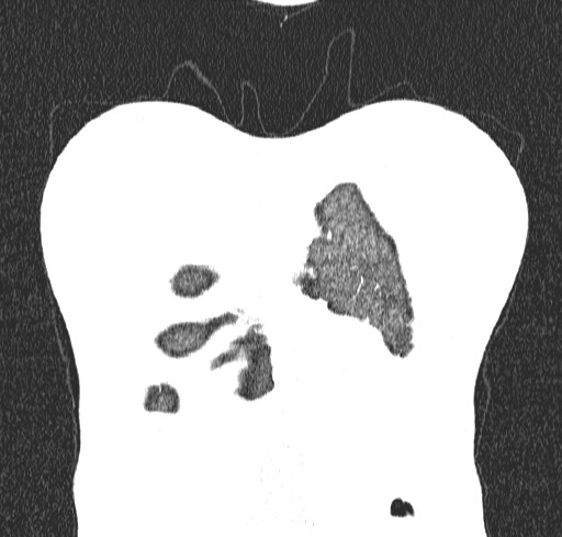 Acute hypersensitivity pneumonitis (Radiopaedia 85293-100870 Coronal lung window 4).jpg