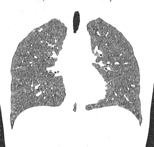 Acute hypersensitivity pneumonitis (Radiopaedia 85293-100870 Coronal lung window 60).jpg