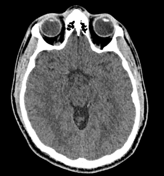 Acute ischemic stroke - posterior circulation territory (Radiopaedia 77670-89881 non-contrast 38).jpg