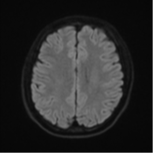 Acute left middle cerebral artery territory infarct with clot retrieval (Radiopaedia 47732-52433 Axial DWI 50).png