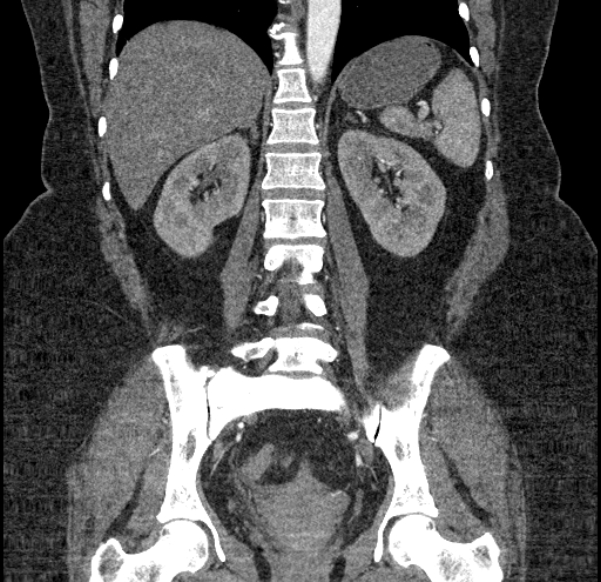 Acute mesenteric ischemia (Radiopaedia 80029-93316 Coronal C+ arterial phase 94).jpg