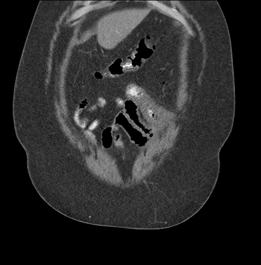 Acute mesenteric venous ischemia (Radiopaedia 46041-50383 Coronal C+ portal venous phase 16).jpg