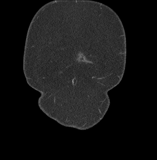 Acute mesenteric venous ischemia (Radiopaedia 46041-50383 Coronal C+ portal venous phase 2).jpg