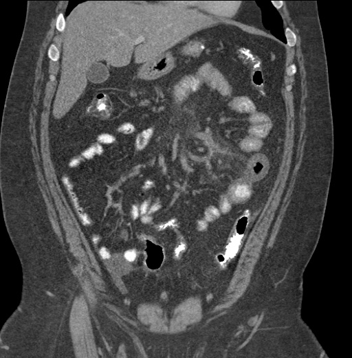 Acute mesenteric venous ischemia (Radiopaedia 46041-50383 Coronal C+ portal venous phase 33).jpg