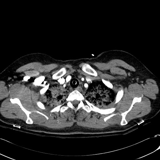 Acute myocardial infarction in CT (Radiopaedia 39947-42415 Axial C+ arterial phase 18).jpg