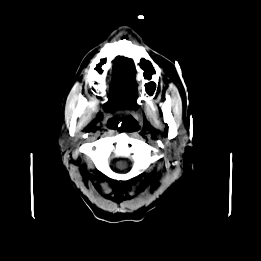 File:Acute necrotizing toxoplasma encephalitis (Radiopaedia 10683-11150 B 33).jpg