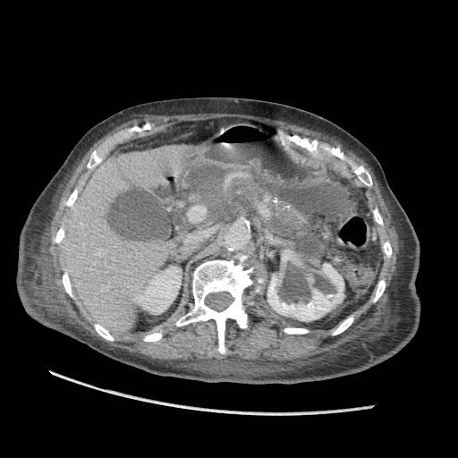 File:Acute on chronic pancreatitis (Radiopaedia 13233-13244 Axial C+ portal venous phase 32).jpg