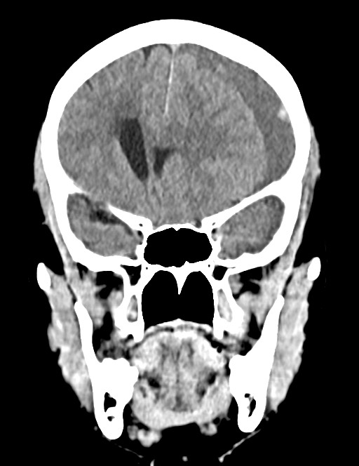Acute on chronic subdural hematoma (Radiopaedia 74814-85823 Coronal non-contrast 25).jpg