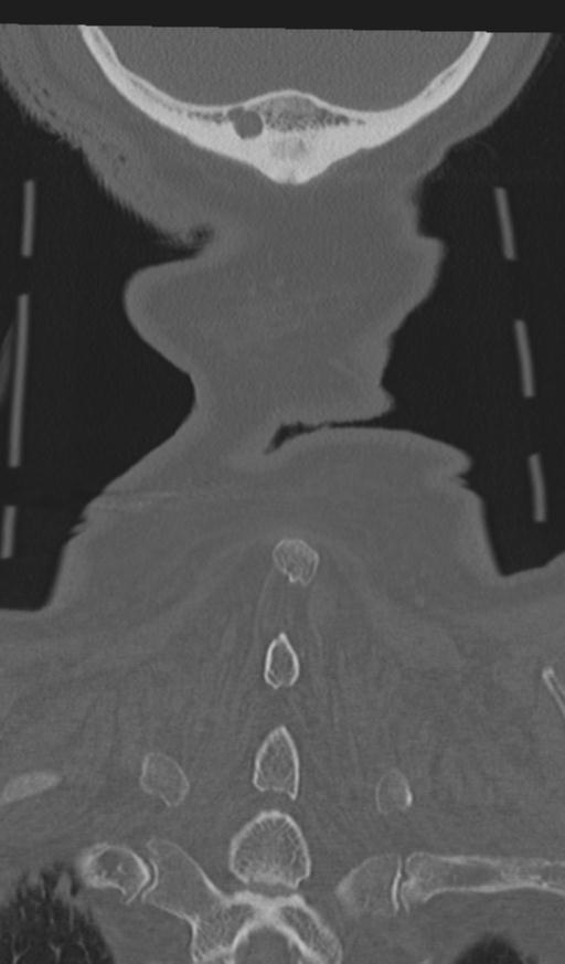 Acute on chronic subdural hematoma and thoracic vertebral injury in a multitrauma patient (Radiopaedia 31698-32619 Coronal bone window 67).jpg