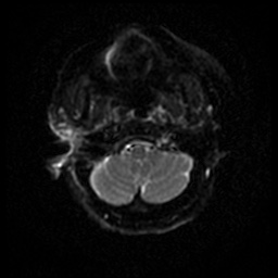 Acute otitis externa (Radiopaedia 57296-64236 Axial DWI 39).jpg