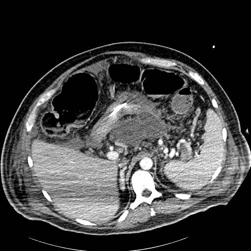 Acute pancreatic necrosis (Radiopaedia 13560-18502 Axial C+ portal venous phase 14).jpg