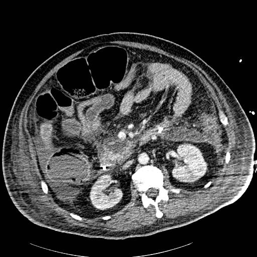Acute pancreatic necrosis (Radiopaedia 13560-18502 Axial C+ portal venous phase 41).jpg