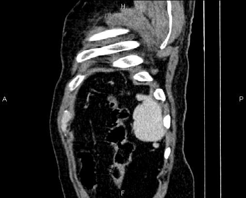 File:Acute pancreatitis (Radiopaedia 85146-100701 Sagittal C+ portal venous phase 89).jpg