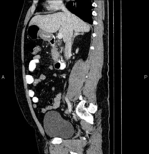 Acute pancreatitis (Radiopaedia 85390-101010 Sagittal C+ portal venous phase 39).jpg