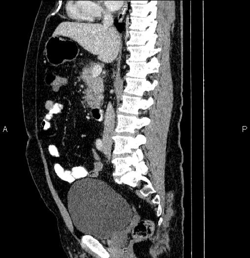 Acute pancreatitis (Radiopaedia 85390-101010 Sagittal C+ portal venous phase 47).jpg