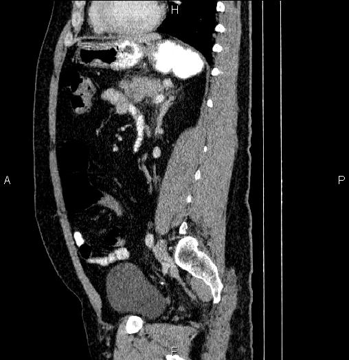 Acute pancreatitis (Radiopaedia 85390-101010 Sagittal C+ portal venous phase 65).jpg