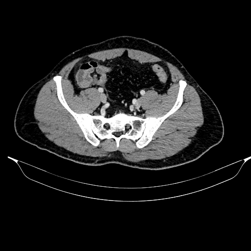 Acute pancreatitis (Radiopaedia 87428-103757 Axial C+ portal venous phase 77).jpg