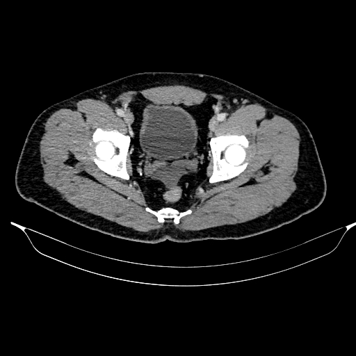 Acute pancreatitis (Radiopaedia 87428-103757 Axial C+ portal venous phase 89).jpg